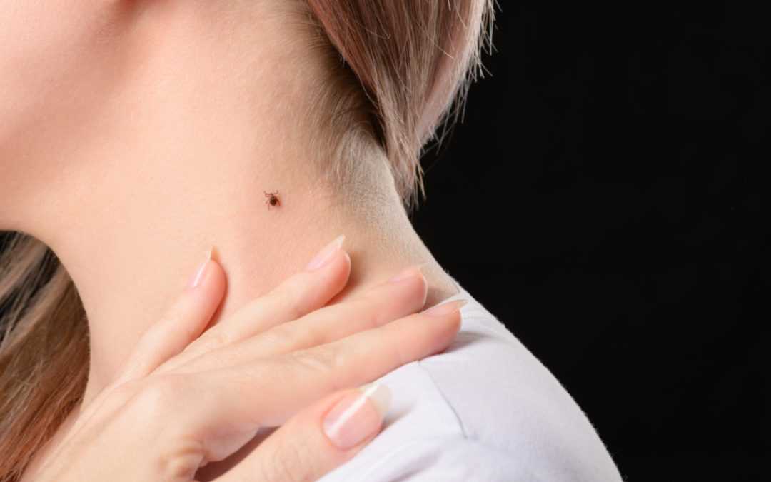 Zeckenbiss – Symptome, Vorgehen bei Infektion und Vorbeugung